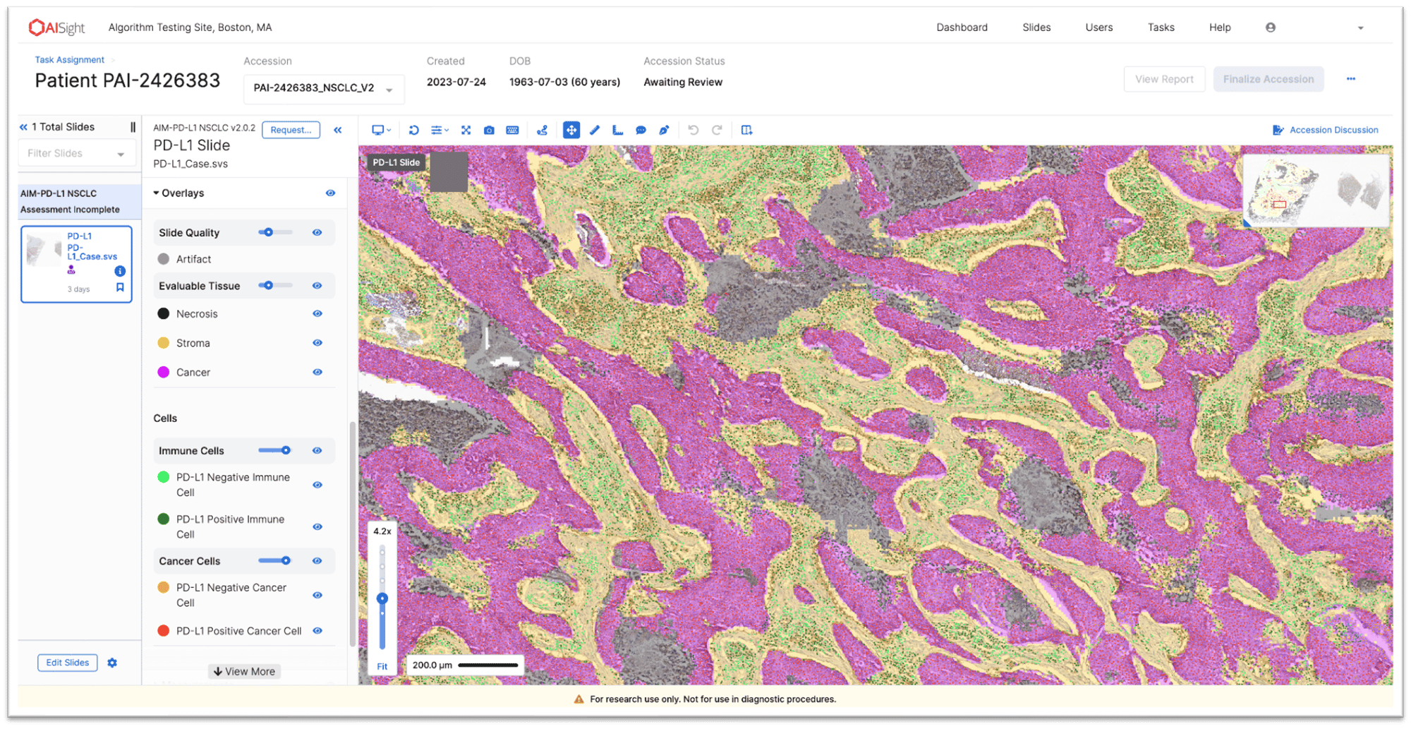AISight-AIM-PD-L1-CellTissueOverlay-1
