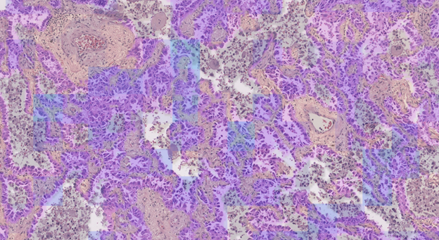 Figure - MET Predict highlights morphological features of the cancer epithelium area associated with MET dysregulation.