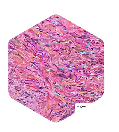 hex-aiproduct-pefibrosis-400